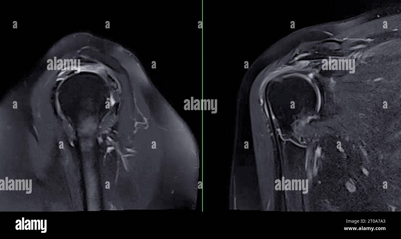 Imagerie par résonance magnétique ou IRM de l'articulation de l'épaule pour le diagnostic de douleur à l'épaule. Banque D'Images
