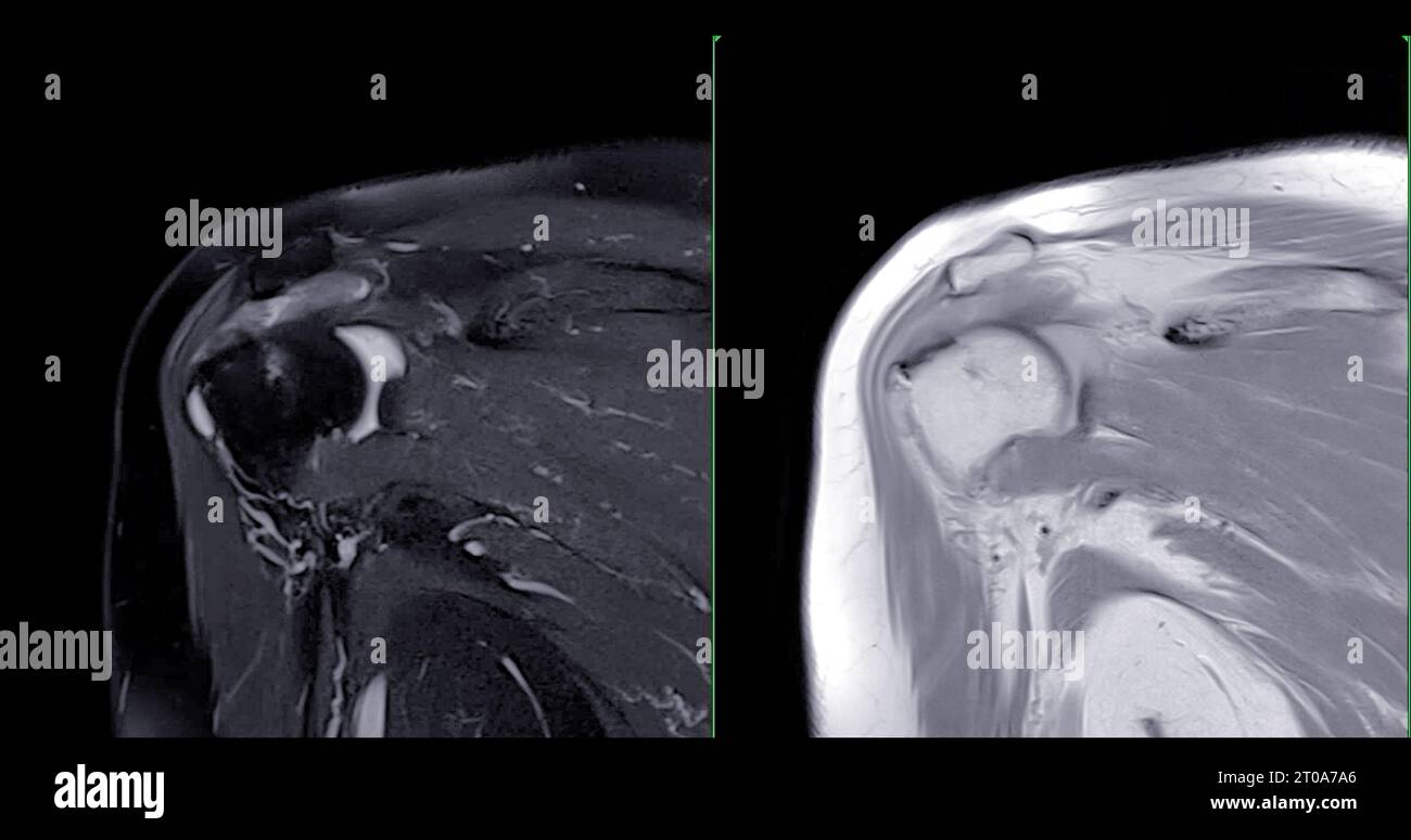 Imagerie par résonance magnétique ou IRM de l'articulation de l'épaule pour le diagnostic de douleur à l'épaule. Banque D'Images
