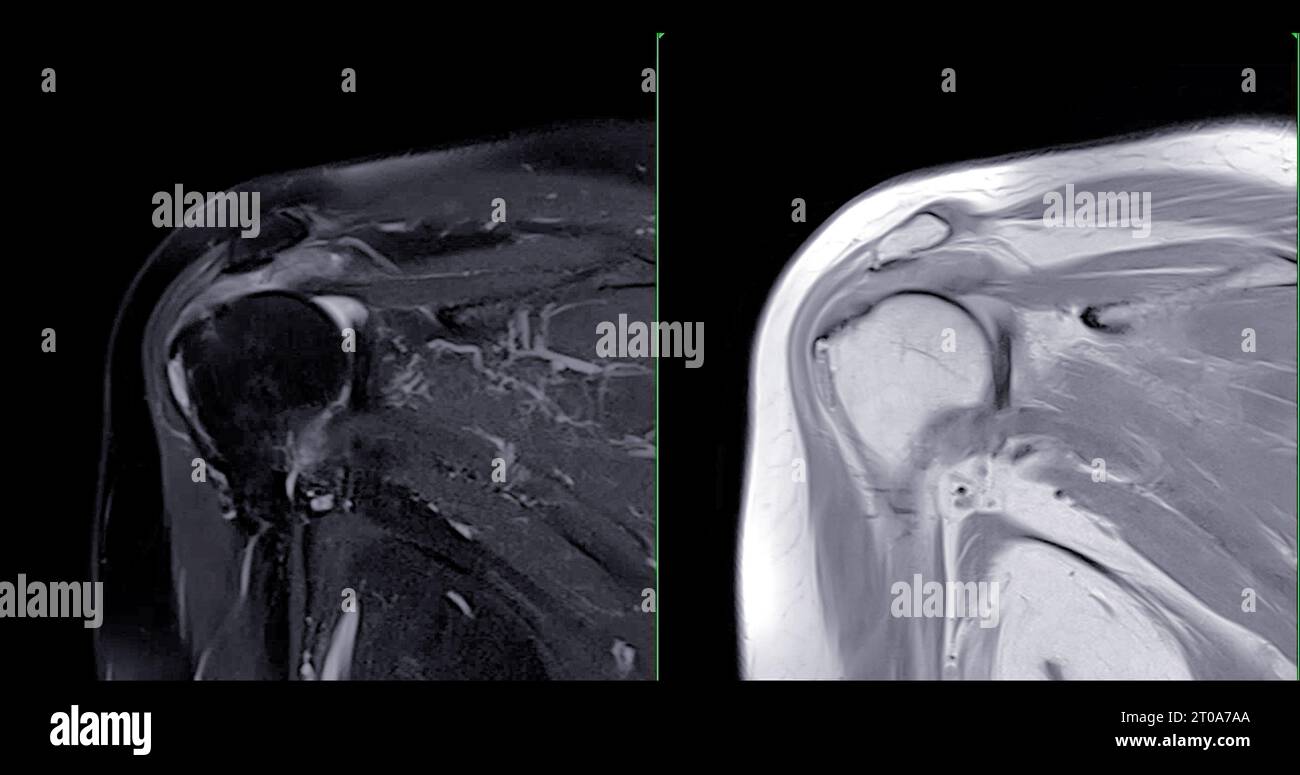 Imagerie par résonance magnétique ou IRM de l'articulation de l'épaule pour le diagnostic de douleur à l'épaule. Banque D'Images