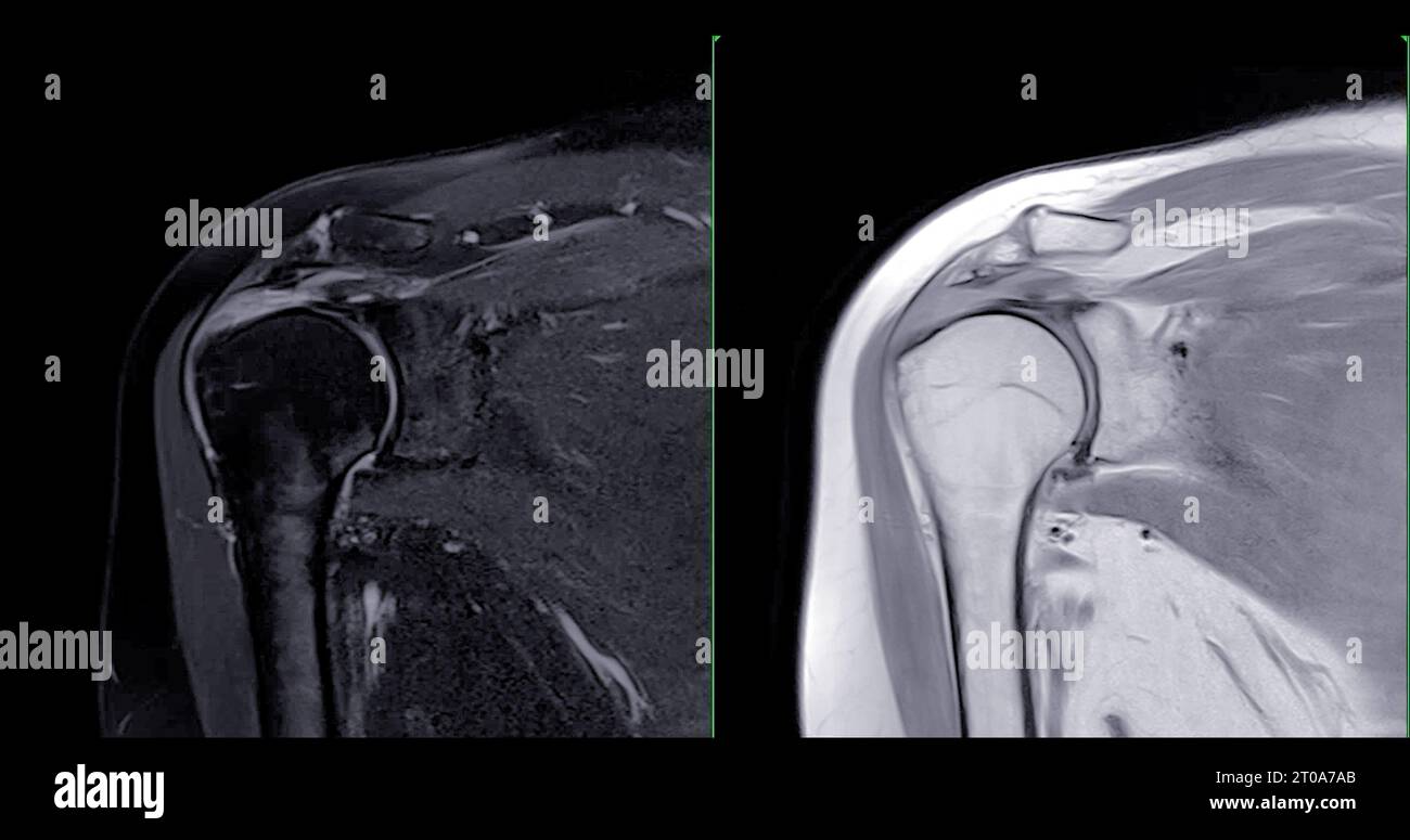 Imagerie par résonance magnétique ou IRM de l'articulation de l'épaule pour le diagnostic de douleur à l'épaule. Banque D'Images
