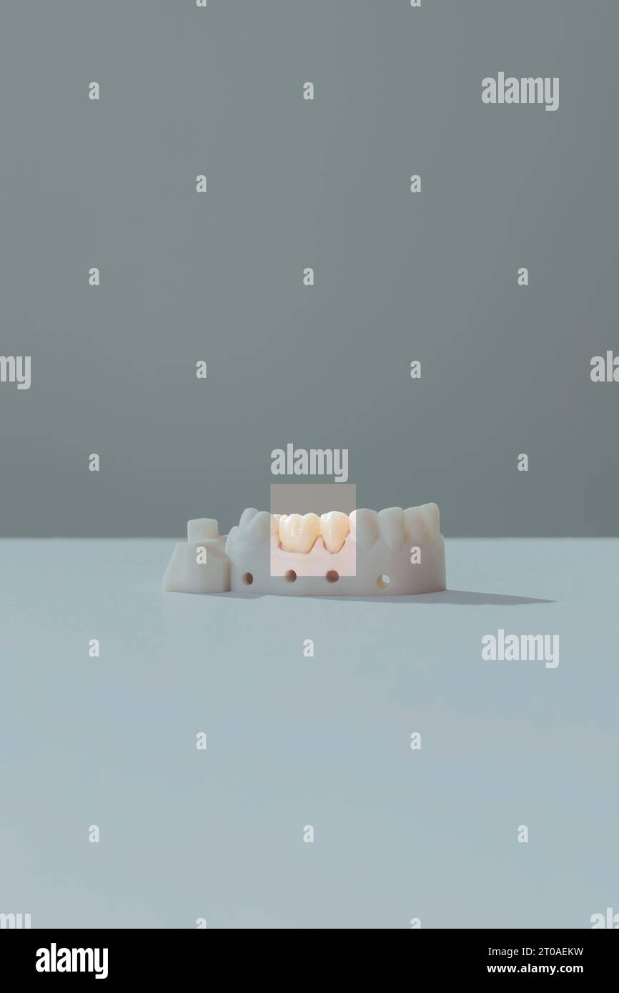 Concevez la couronne de dent ou le capuchon dentaire sur le support de dent de modèle d'implant. Préparation de la dent molaire pour la mise en place du Bridge. Plan vertical, Copier l'espace pour le texte Banque D'Images