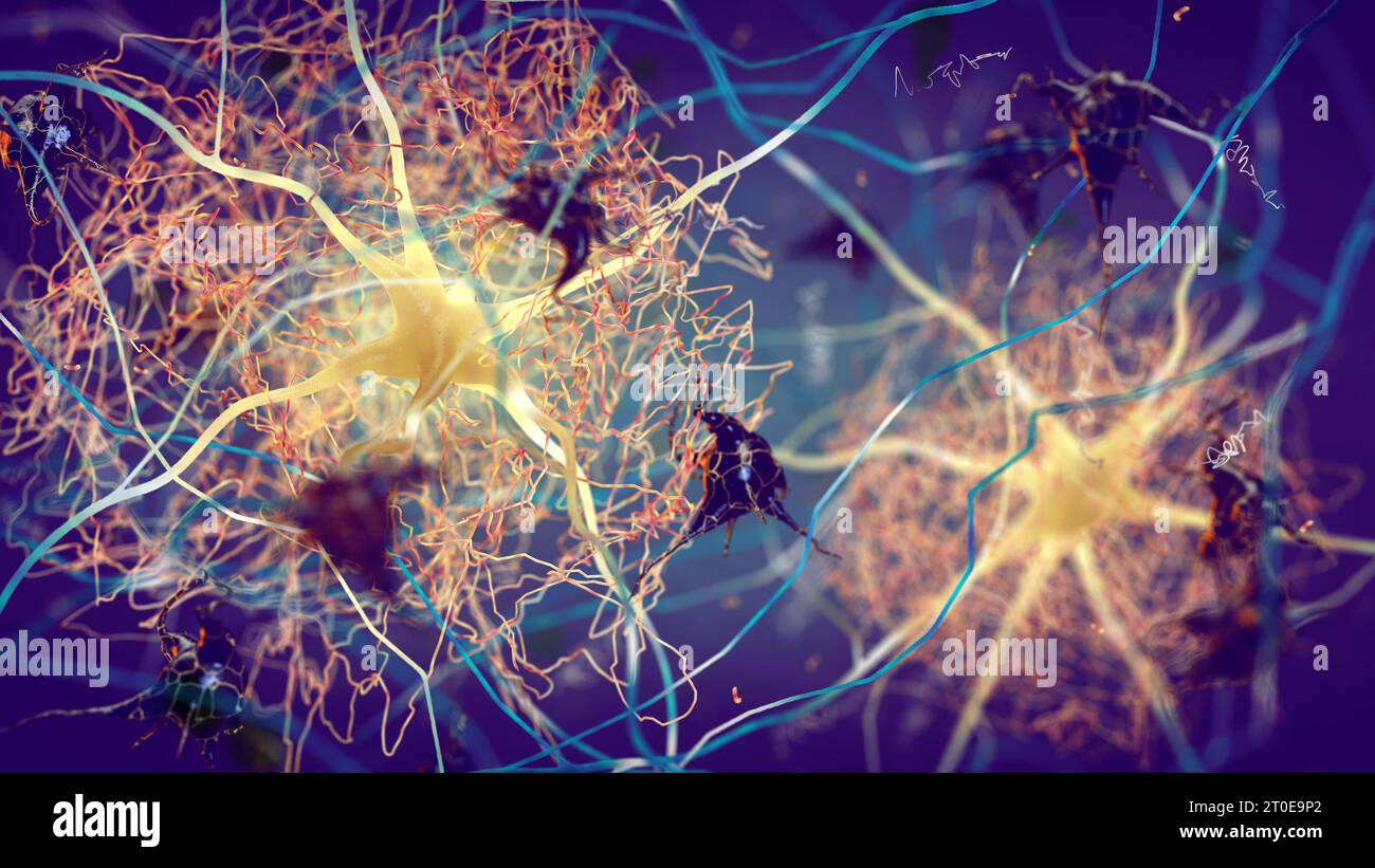 Plaques amyloïdes se formant entre les neurones. La protéine bêta ...
