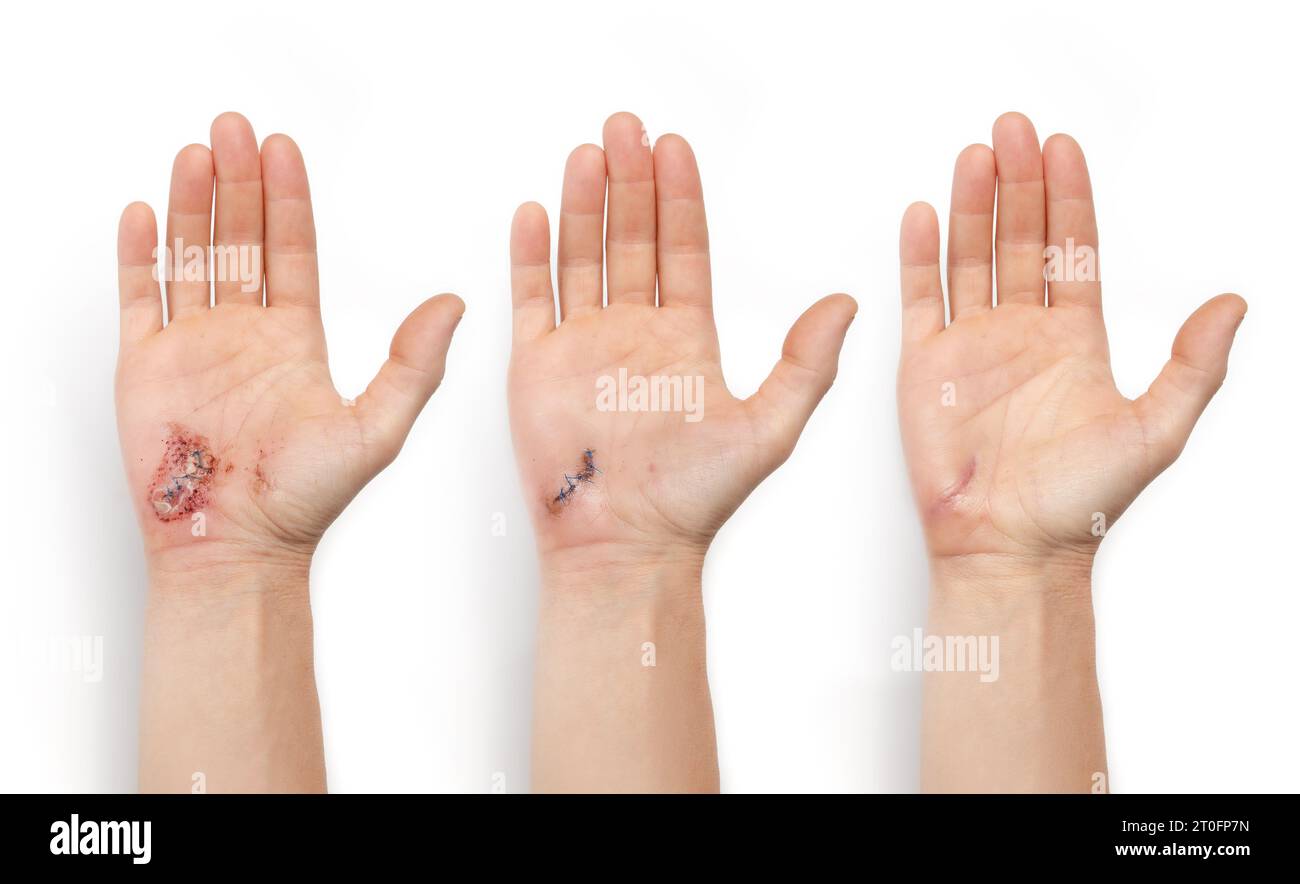 Visualisation de la cicatrisation de la main avec lacération et points de suture. Main femelle