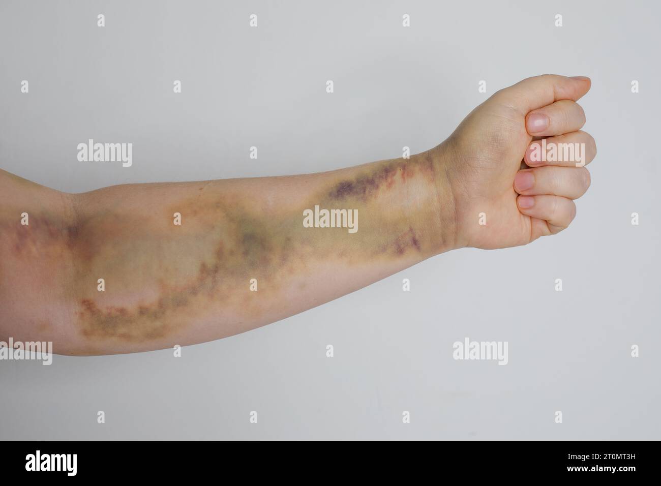 Main féminine avec cicatrice d'accident de voiture et ecchymose Banque D'Images