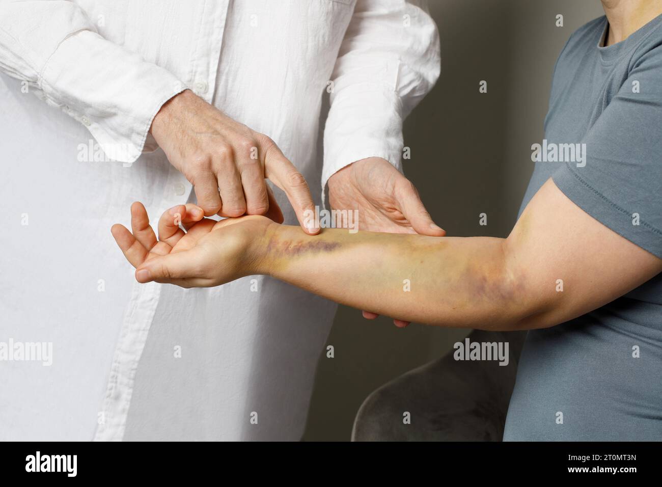 Docteur examinant les ecchymoses sur le bras de sa patiente. Médecine et concept de traitement Banque D'Images