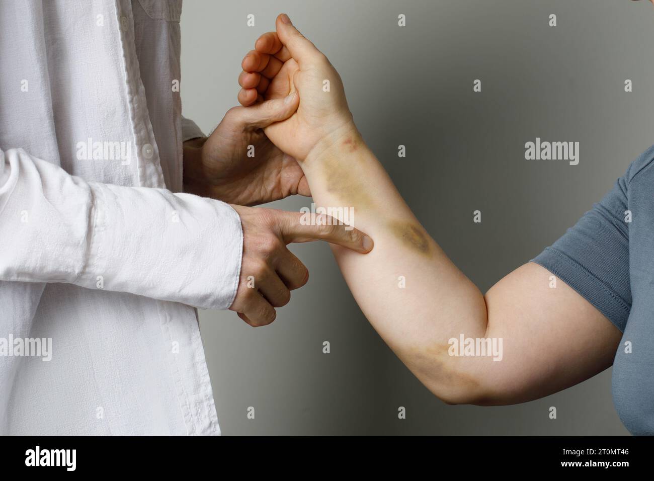 Ecchymoses et blessures causées par une collision, un impact ou une chute. Femme avec la peau contusionnée et médecin Banque D'Images