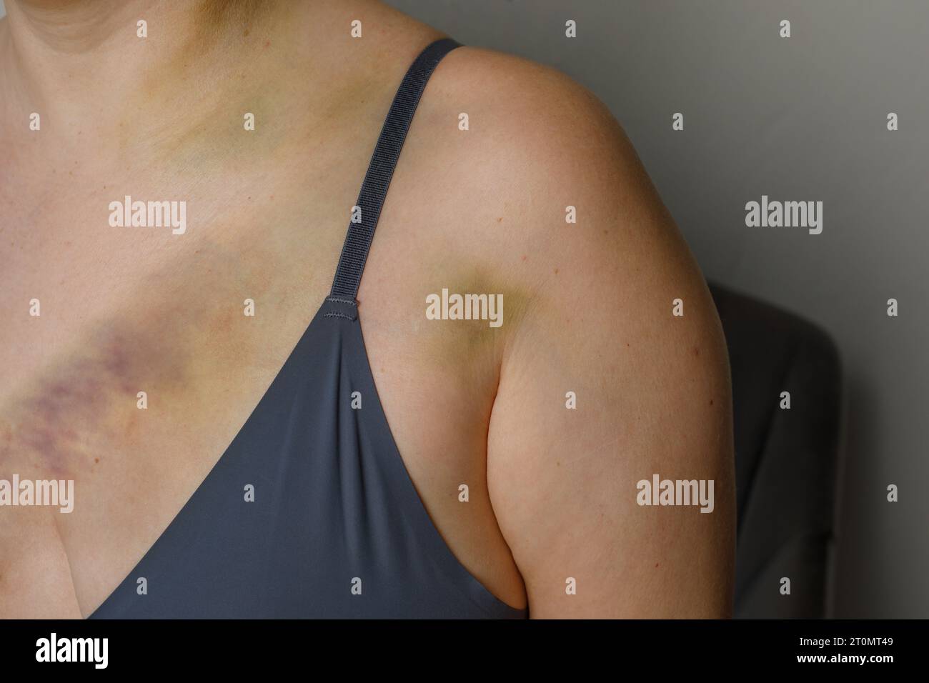 Ecchymose sur la peau de la femme en gros plan Banque D'Images