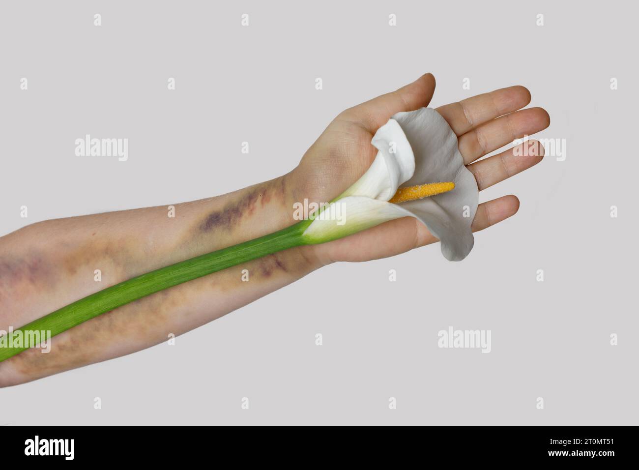 Ecchymose sur le bras de la femme. Ecchymoses d'injection Banque D'Images