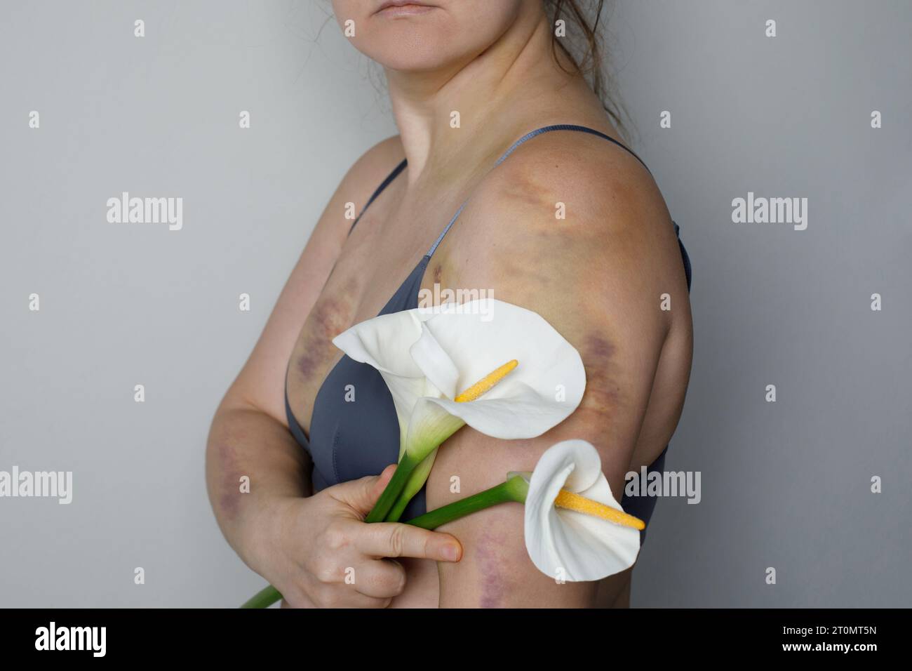 Blessure à la cuisse due à une collision, un impact ou une chute, ecchymose de la peau de la femme. Ecchymose sur les gens Banque D'Images