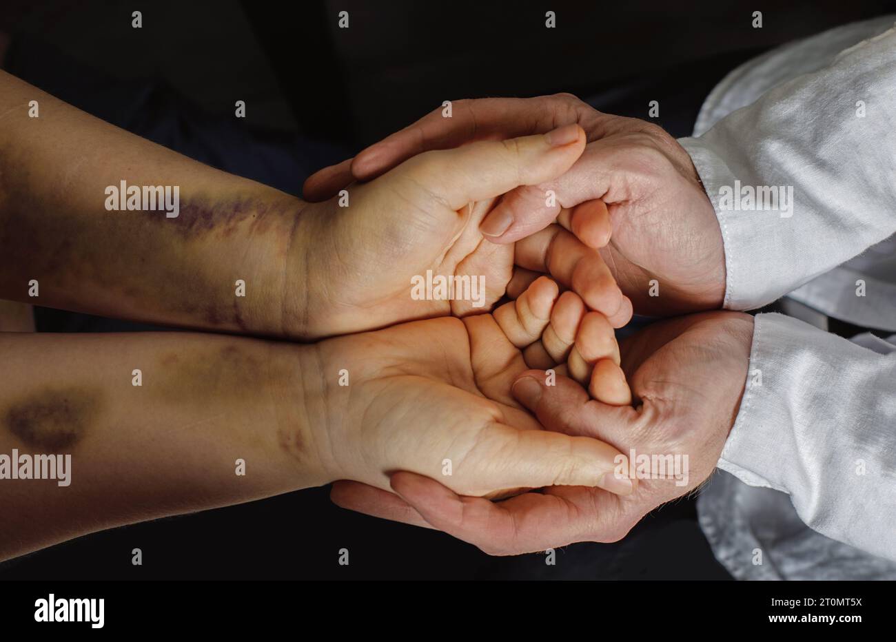 Docteur nand tenant la main du patient avec des ecchymoses traumatiques à l'hôpital ou dans un abri. Concept de soutien médical et social. Banque D'Images