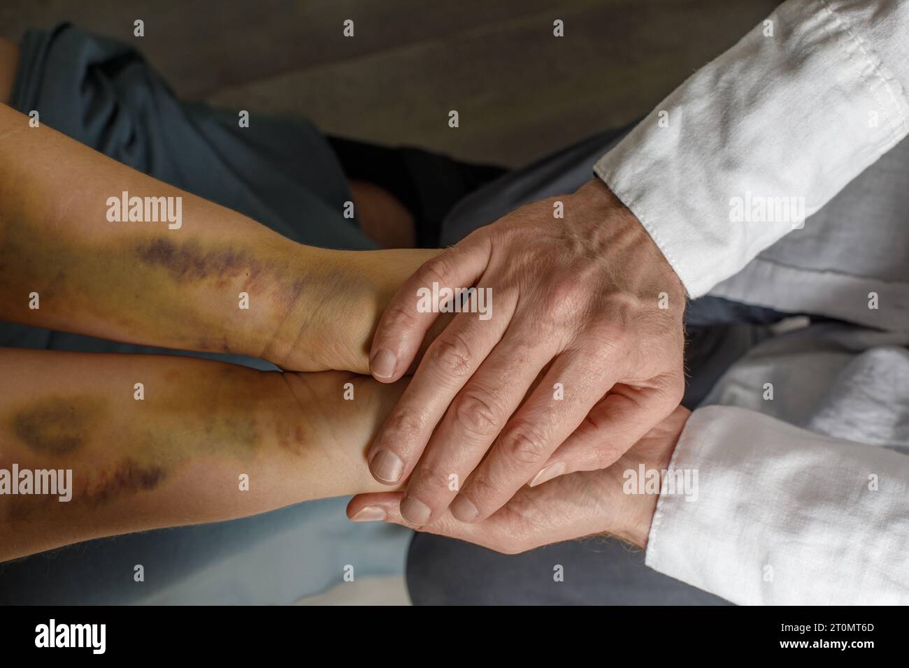 Soutien aux victimes de violence domestique. Main féminine avec des ecchymoses et gros plan de la main du médecin. Banque D'Images