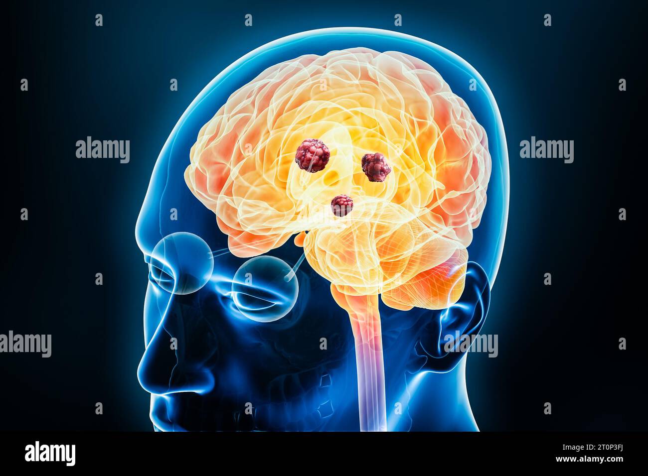 Cancer cerveau avec des cellules cancéreuses ou des tumeurs X-ray 3D rendu illustration avec le corps. Anatomie, maladies neurologiques, oncologie, médecine, psychologie, s Banque D'Images