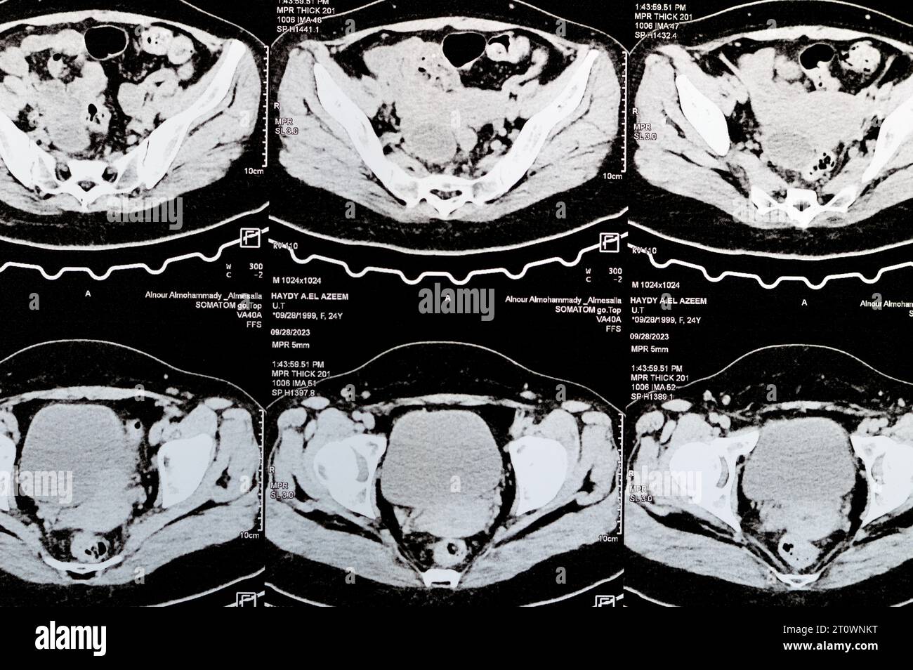 Le Caire, Égypte, octobre 3 2023 : le scanner multi-coupes de l'abdomen et du bassin montre un kyste de l'ovaire droit de 3 x 3 cm, une distension gazeuse colique, pas d'urine importante Banque D'Images