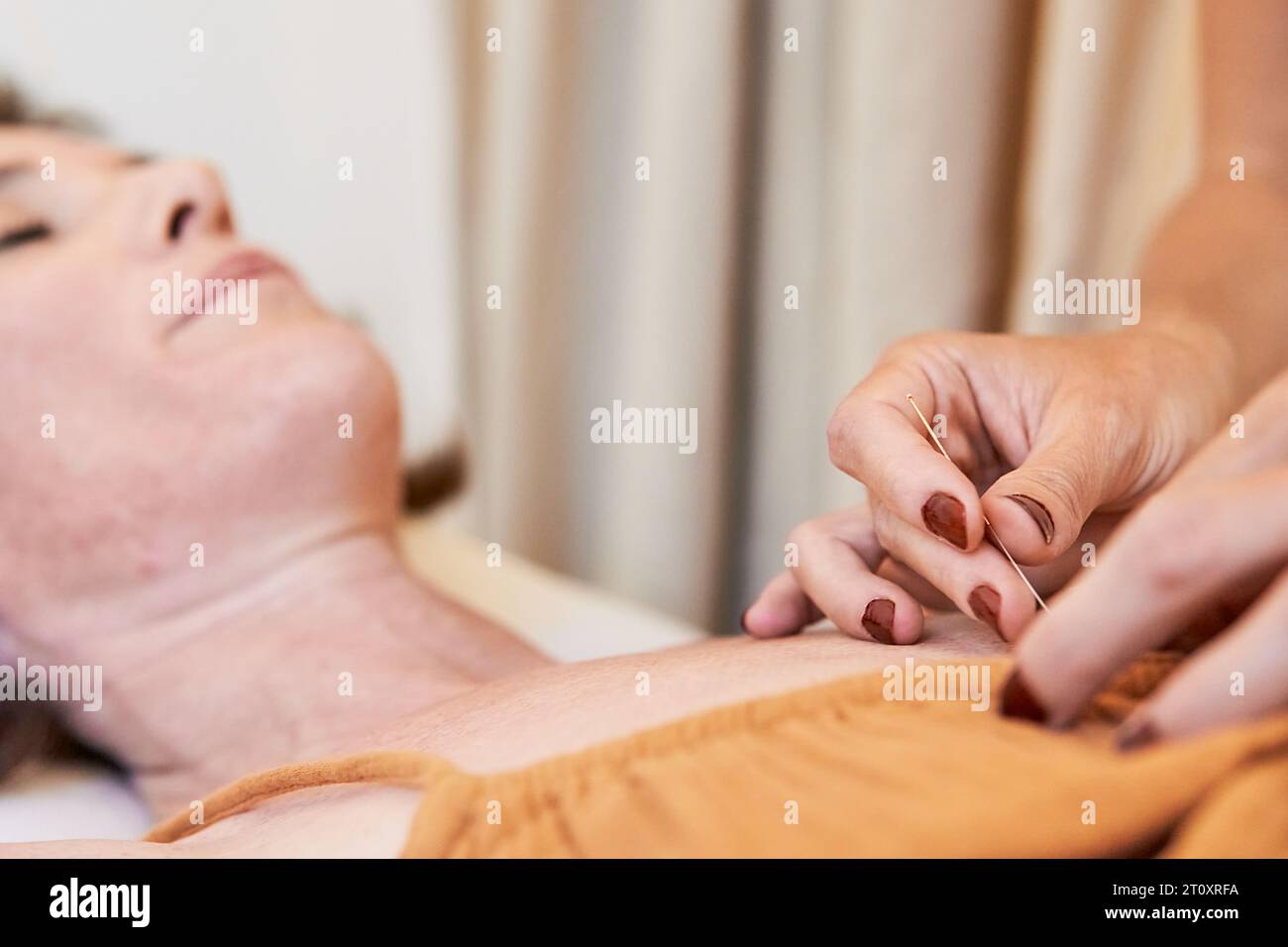 Une aiguille d'acupuncture appliquée sur la poitrine d'une femme dans un centre de thérapies alternatives Banque D'Images