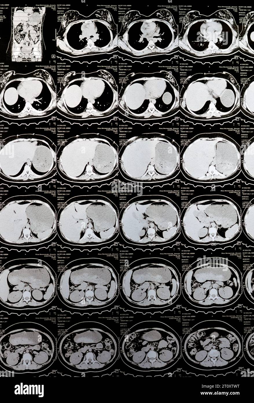 Le Caire, Égypte, octobre 3 2023 : le scanner multi-coupes de l'abdomen et du bassin montre un kyste de l'ovaire droit de 3 x 3 cm, une distension gazeuse colique, pas d'urine importante Banque D'Images