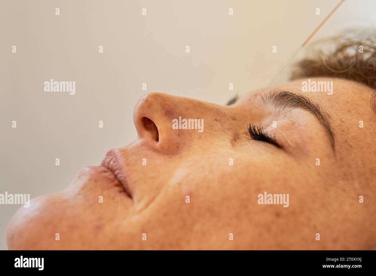 Gros plan du visage d'une femme avec une aiguille d'acupuncture sur le point de pression Yin Tang du front Banque D'Images