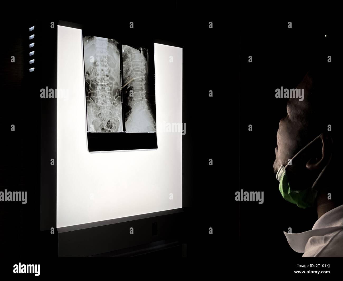 Le médecin diagnostique la maladie de cancer d'os de santé du patient avec des lésions radiologiques à la tomodensitométrie de jambe du patient ou film de rayons X pour la santé médicaleca Banque D'Images