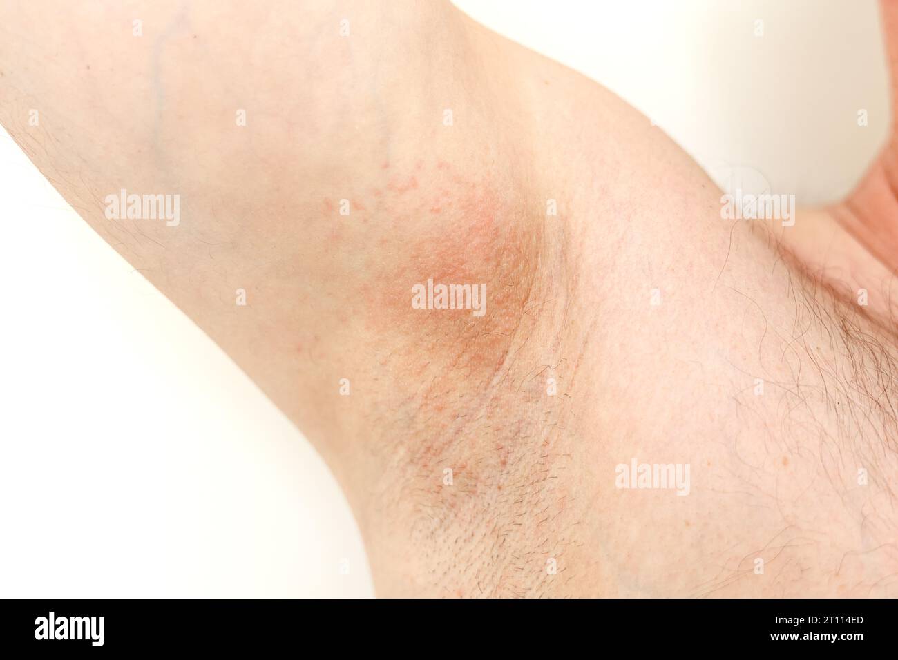 Allergie aux aisselles. Photo recadrée d'irritation, d'inflammation sur la  peau sensible après utilisation d'un rasoir, d'une tondeuse, d'un déodorant  toxique ou d'un antisudorifique. Bras Photo Stock - Alamy