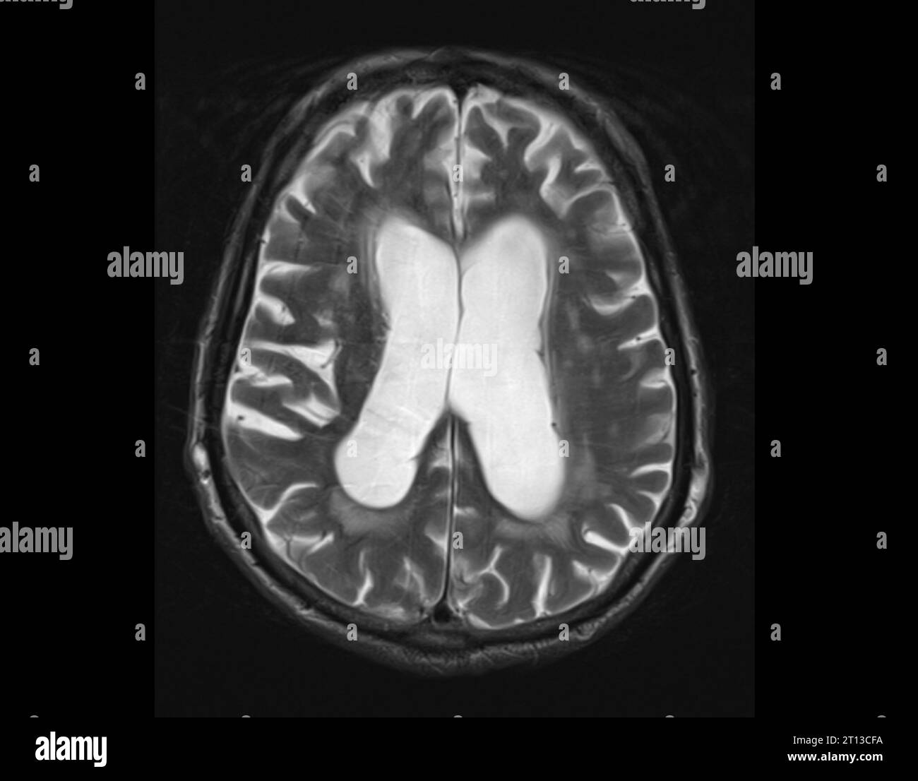 IRM et tomodensitométrie (TDM) composites du cerveau d'un homme de 90 ans atteint de démence frontotemporale. Il montre une atrophie sévère (rétrécissement) à l'avant (haut) du cerveau. La démence frontotemporale est une forme rare de démence qui provoque des changements de comportement et des difficultés de langage. Banque D'Images