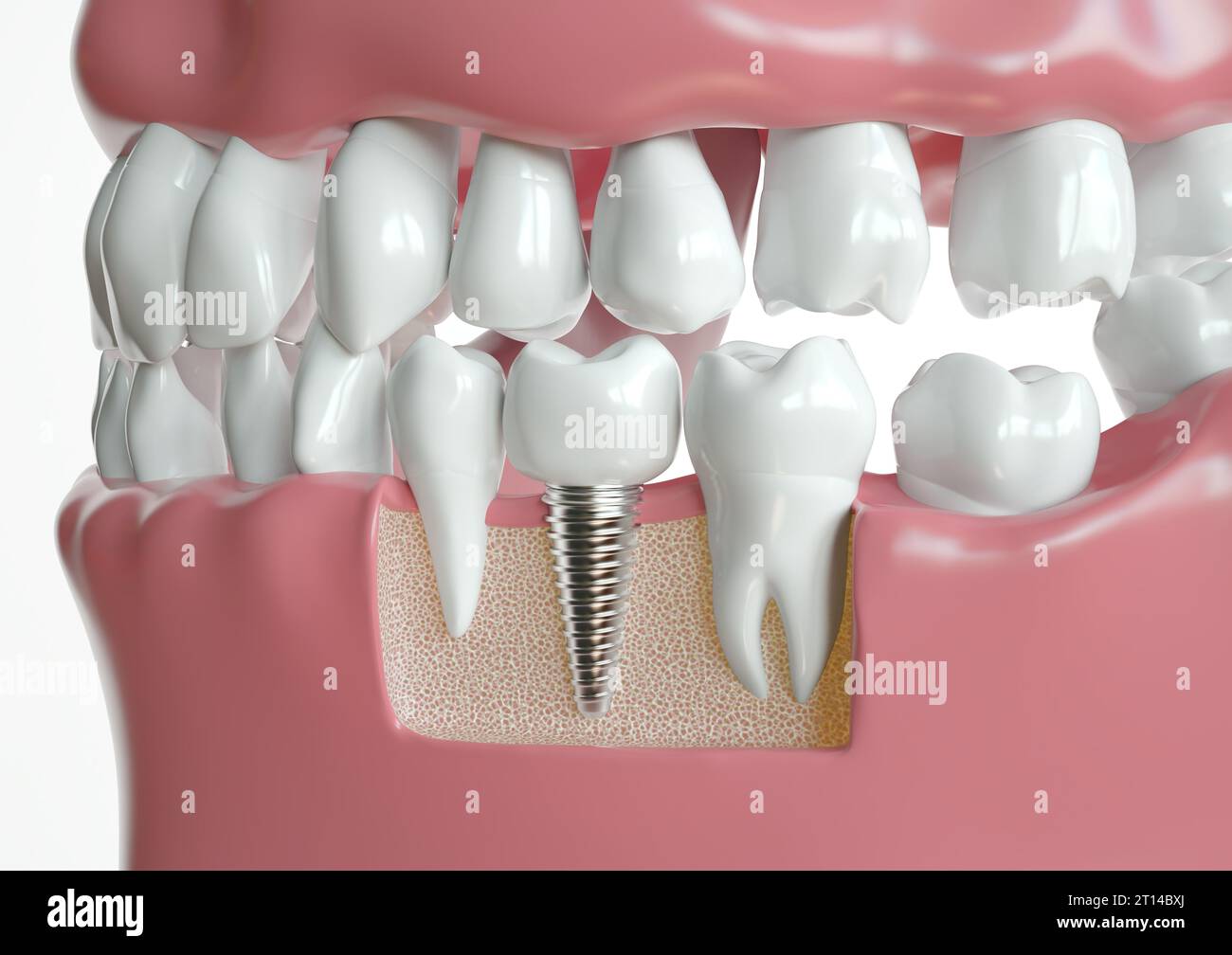 Intégration de l'implant dans la visualisation de l'anatomie des mâchoires - rendu 3D. Banque D'Images