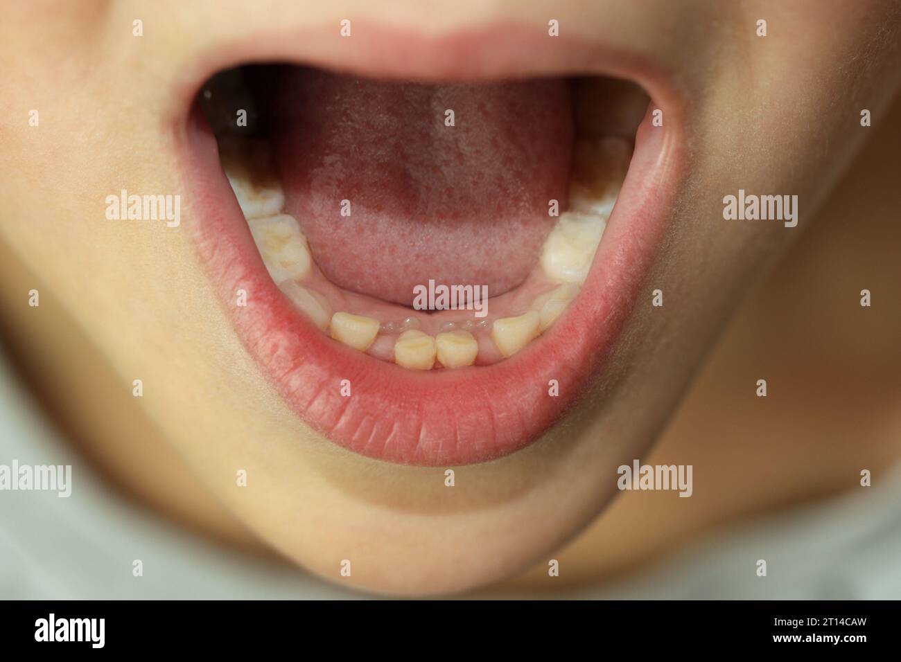 Les dents permanentes d'un enfant poussent à côté des dents de bébé qui ne sont pas tombées. Deuxième rangée de dents. Dentisterie. Un concept médical. Les dents changent. Banque D'Images