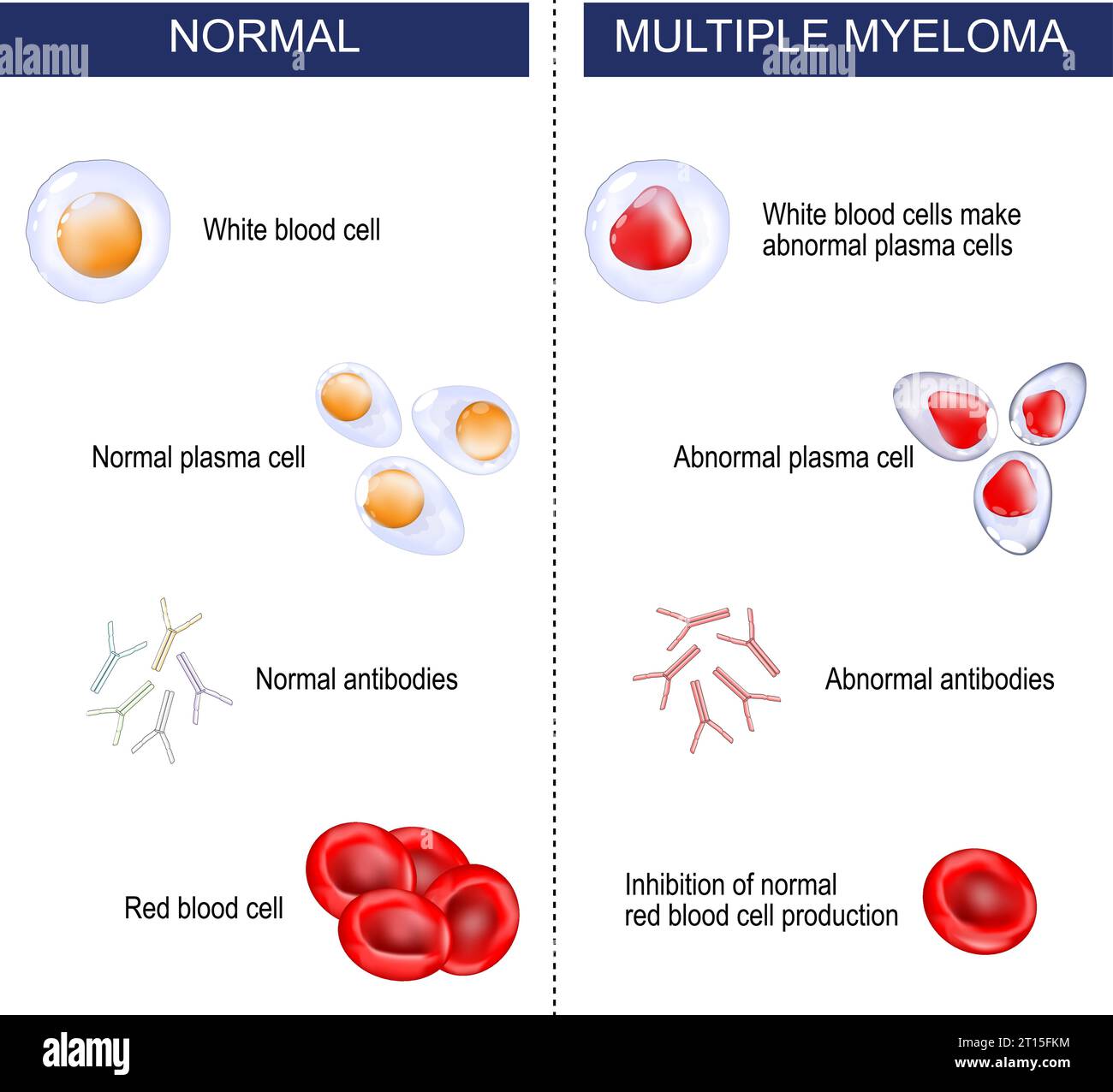 Myélome multiple. Différence entre malignité normale et hématologique. les leucocytes mutent et produisent des plasmocytes anormaux. Le myélome supprime le grognement Illustration de Vecteur