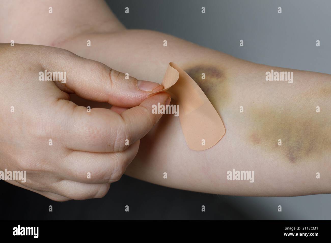 Main avec ecchymose et bande d'aide gros plan Banque D'Images