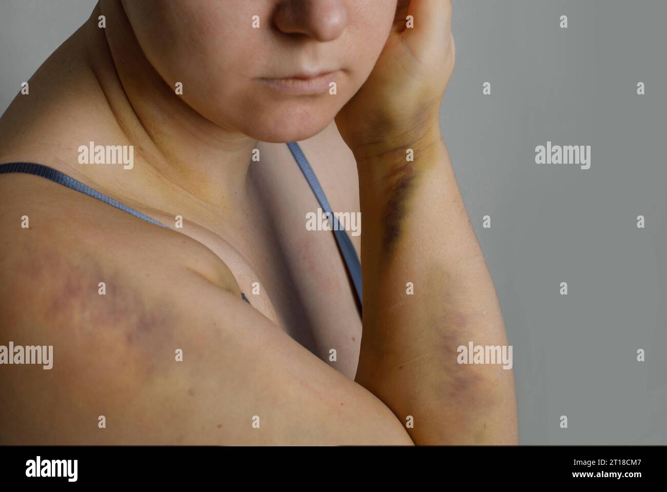 Un corps de femme avec des traces de violence. Ecchymoses et abrasions. Le concept de liberté et de protection des femmes Banque D'Images