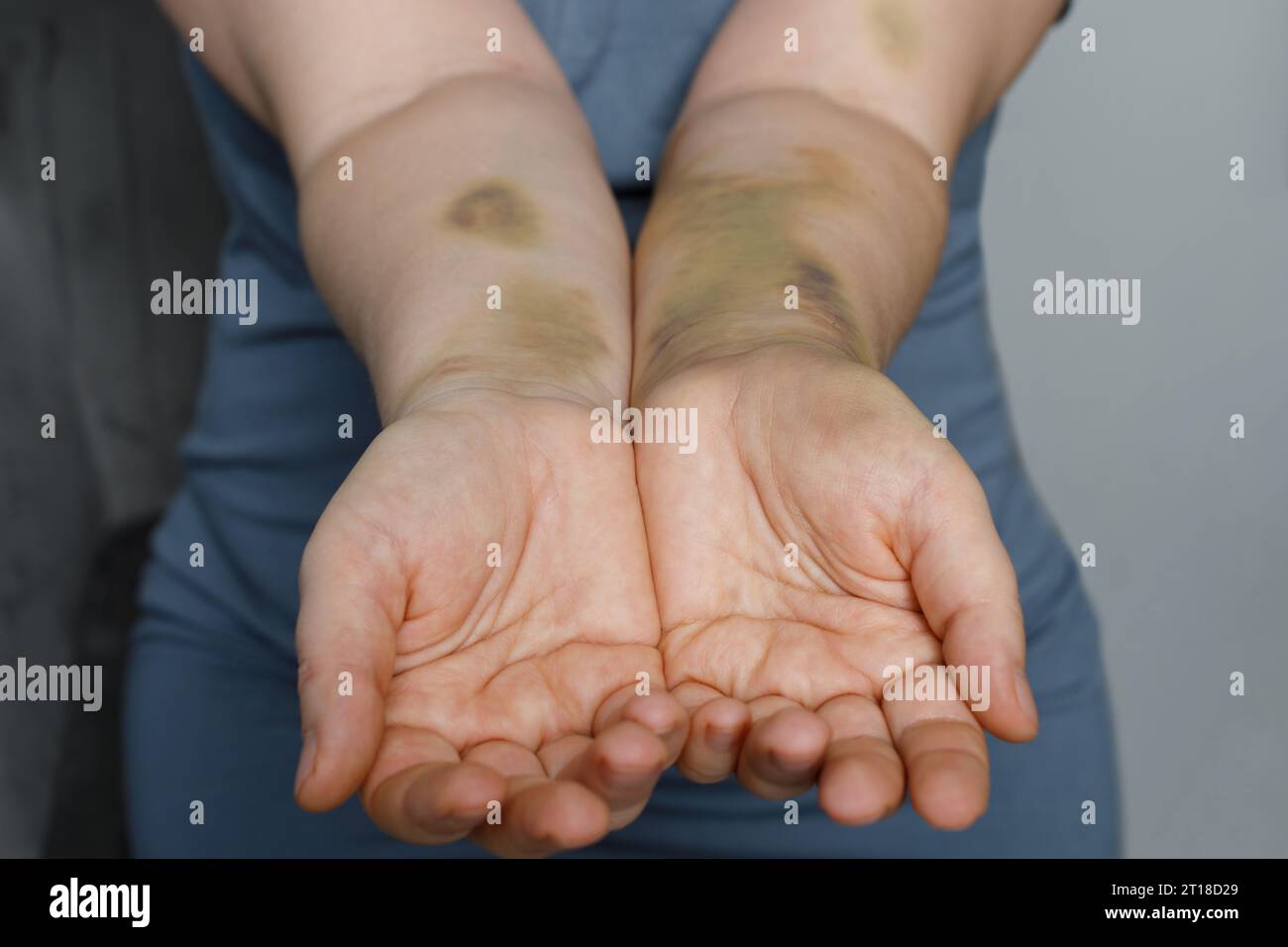 Main féminine avec cicatrice d'accident de voiture. Main féminine avec ecchymose Banque D'Images