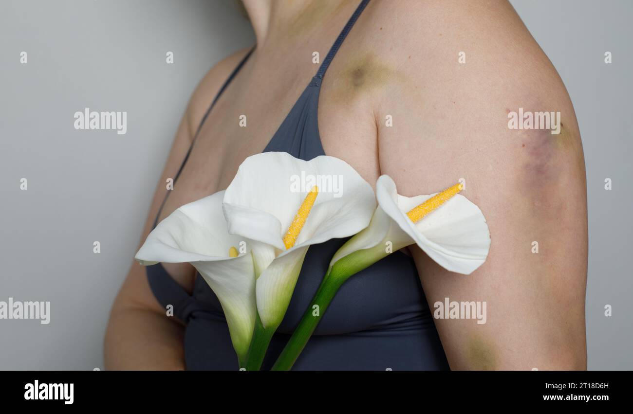 Femme avec cicatrice d'accident de voiture en gros plan Banque D'Images