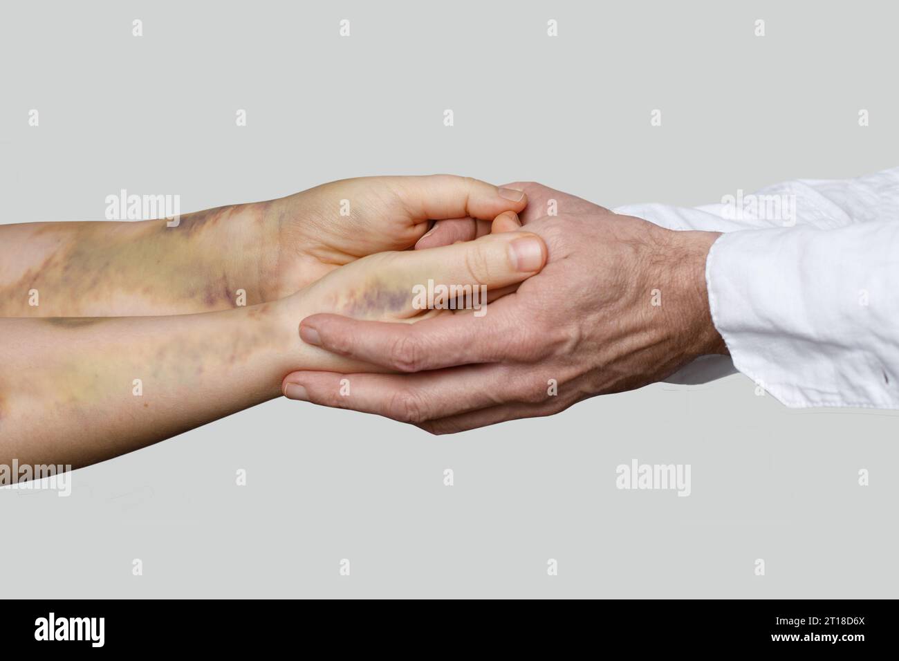 Patient avec ecchymoses et gros plan de la main du médecin. Soutien aux victimes de violence domestique Banque D'Images