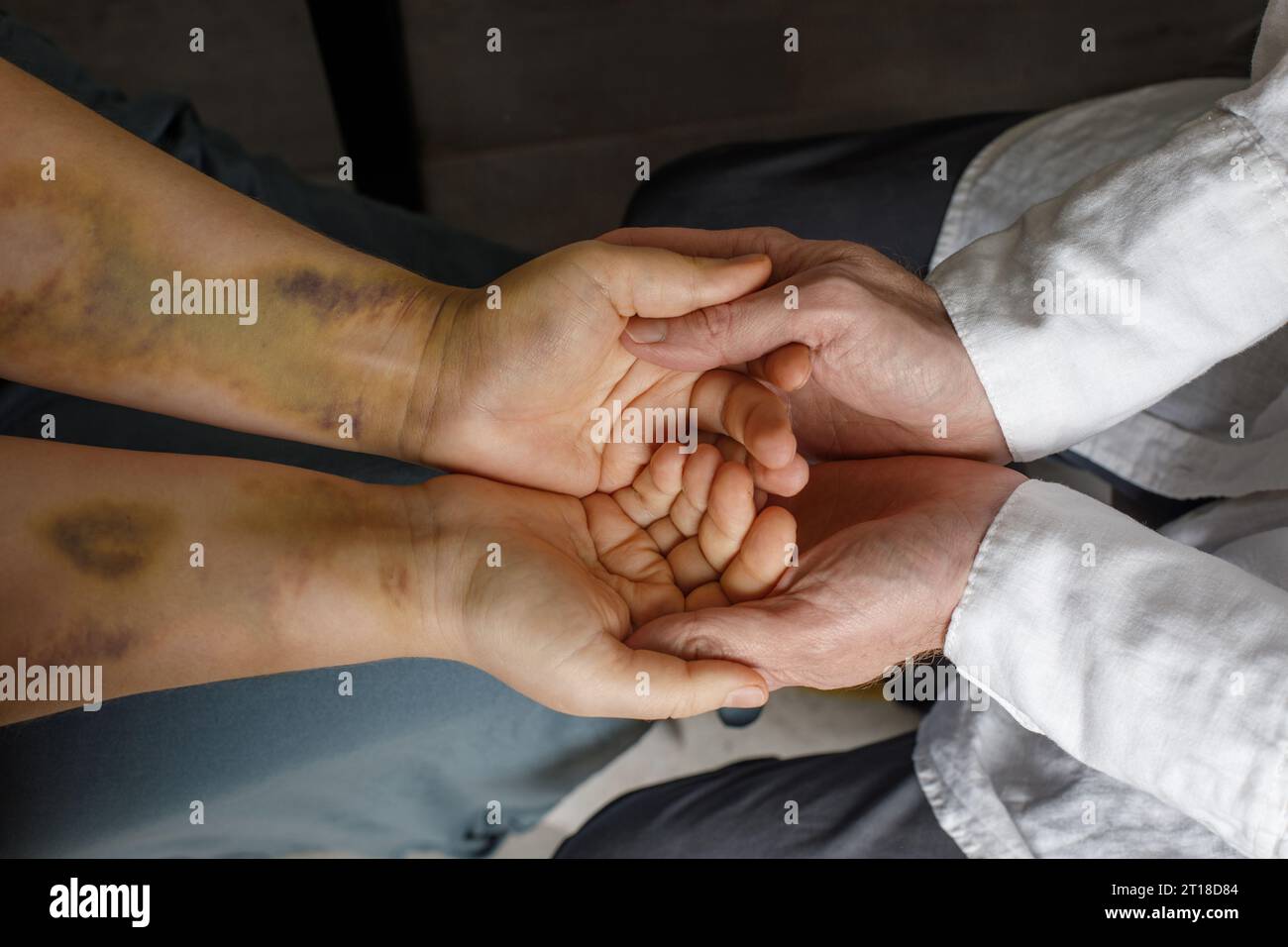 Ecchymose sur le bras du patient et gros plan de la main du médecin. Aide, médecine et traitement pour le concept de patient Banque D'Images