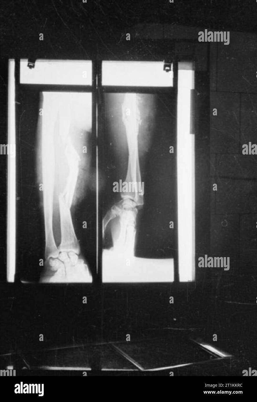 Guy's Hospital- La vie dans un hôpital de Londres, Angleterre, 1941 Une photographie de la x-ray de la fracture de bras d'un homme qui a protégé sa tête avec son bras, de protéger sa tête de tomber la maçonnerie lorsqu'une maison est tombée sur lui. Banque D'Images