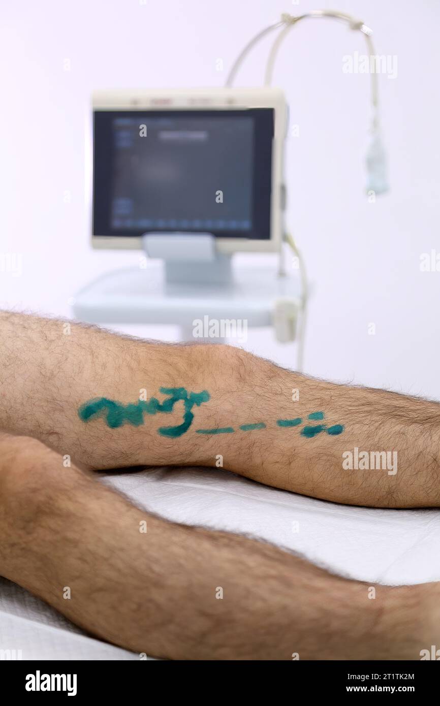 Chirurgie médicale de la photocoagulation endoveineuse au laser de la