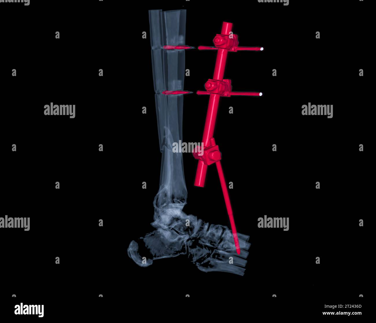 Image de rendu 3D de l'articulation de la cheville par tomodensitométrie montrant la fracture du tibia et du péroné avec une plaque et une fixation par vis pour maintenir les os en place et aider Banque D'Images