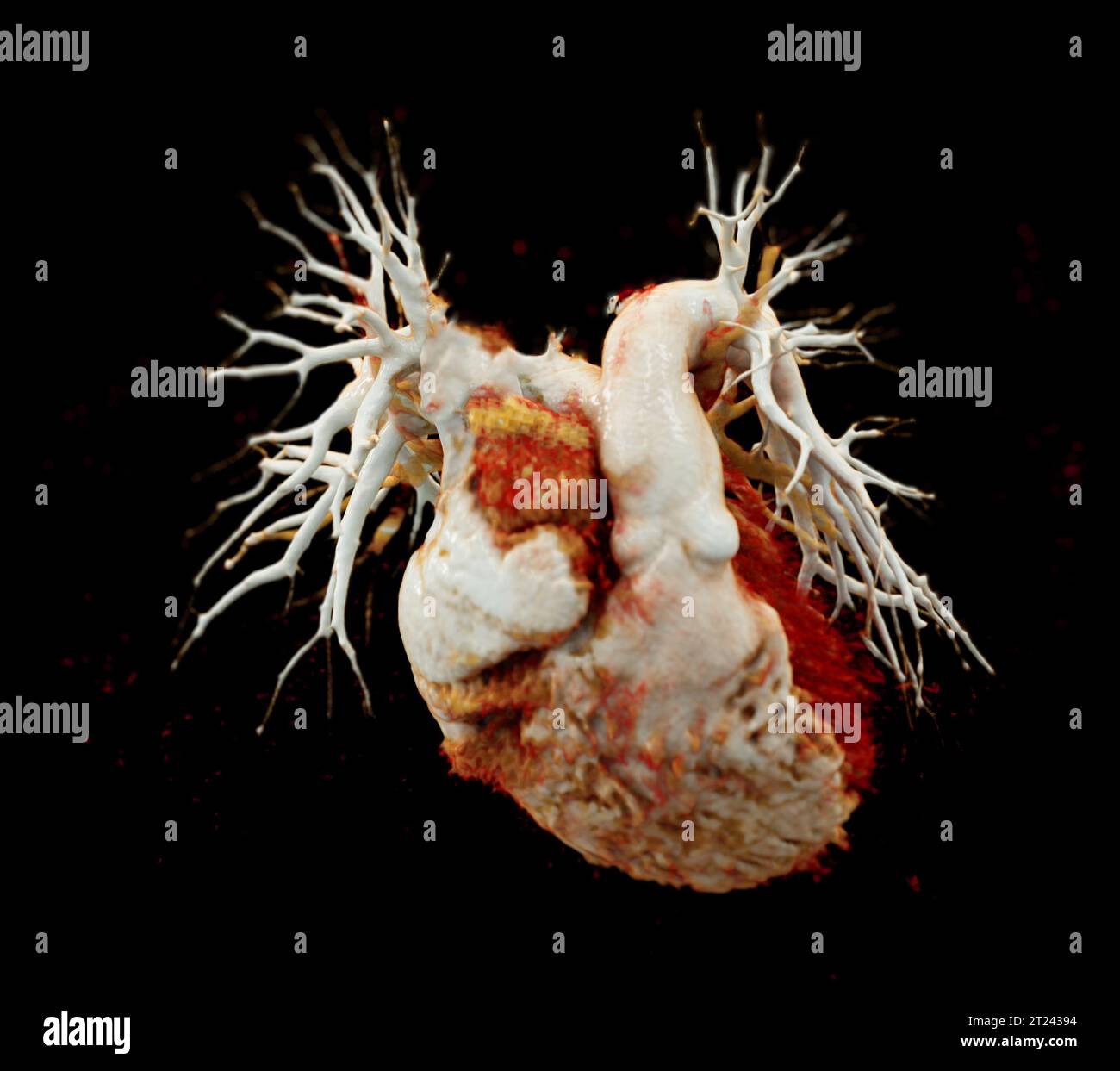 CTA thorax ou CTPA avec produit de contraste rendu 3D pour diagnostic d'embolie pulmonaire (EP) . Banque D'Images