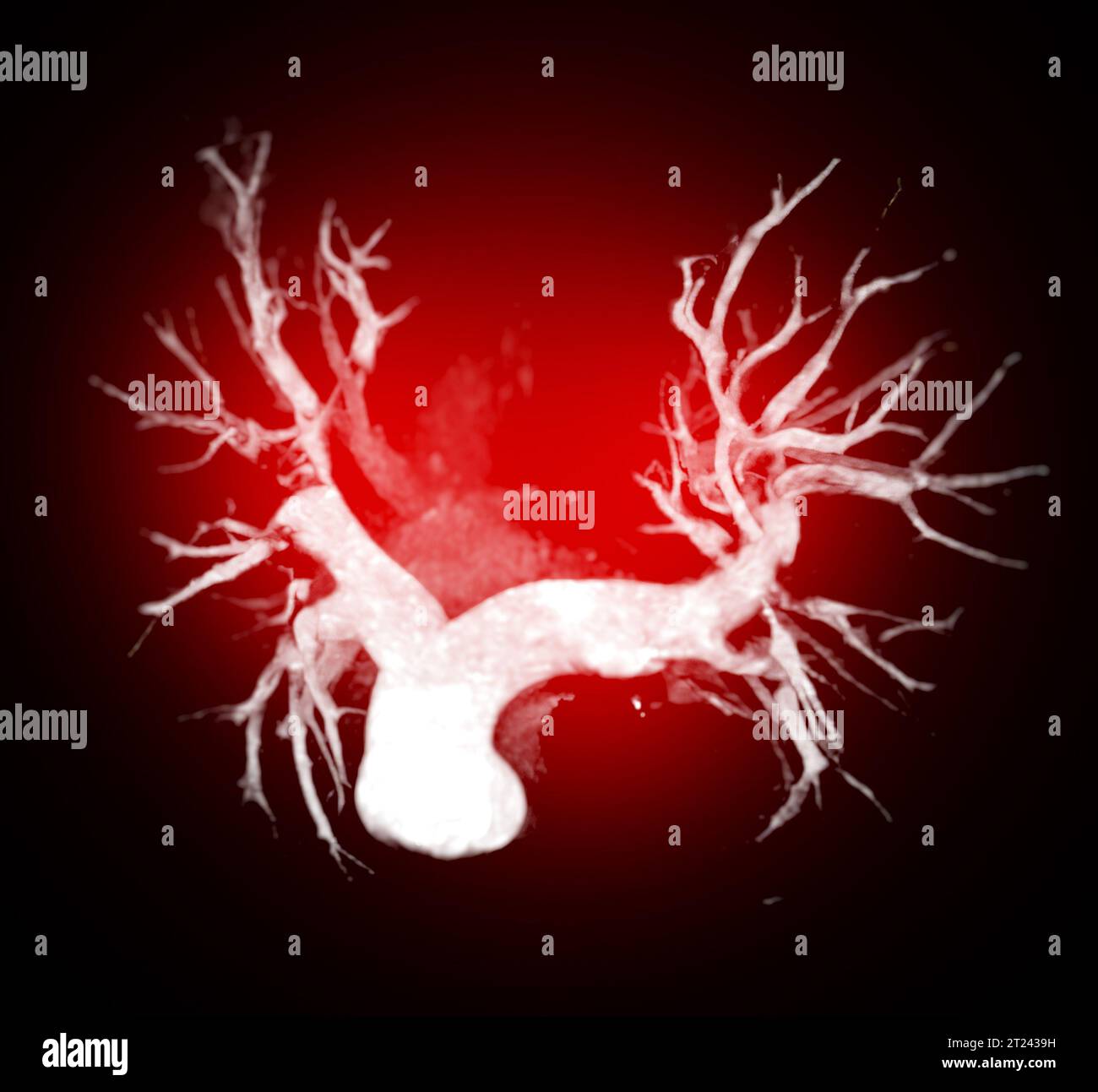 CTA thorax ou CTPA avec produit de contraste rendu 3D pour diagnostic d'embolie pulmonaire (EP) . Banque D'Images