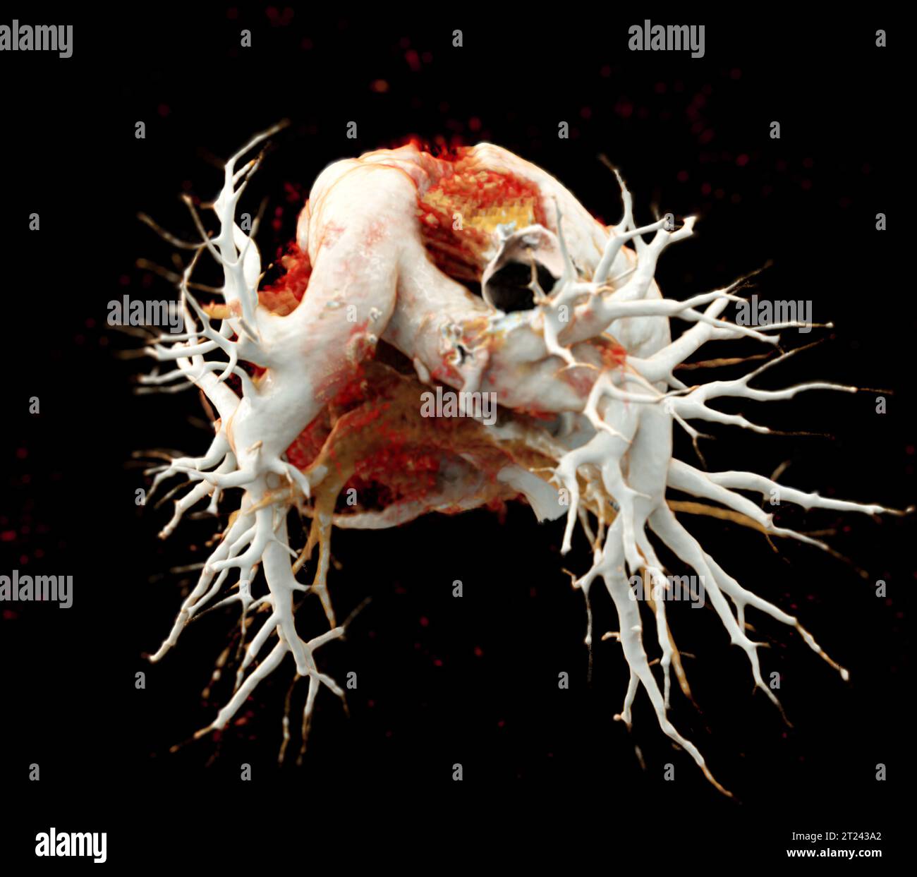 CTA thorax ou CTPA avec produit de contraste rendu 3D pour diagnostic d'embolie pulmonaire (EP) . Banque D'Images