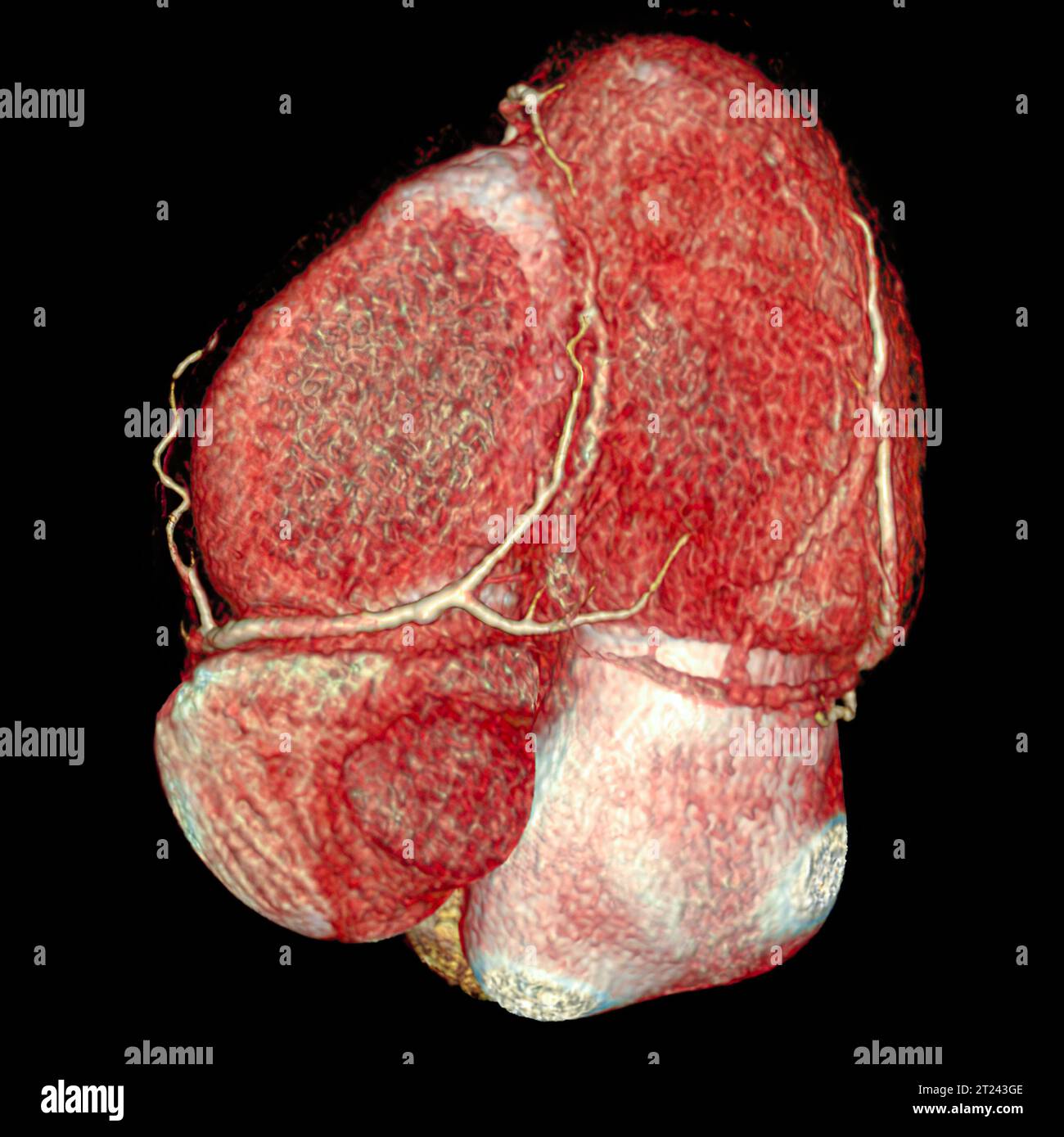 Image de rendu 3D de l'artère coronaire CTA. Angiographie tomodensitométrique dans les cardiopathies. Banque D'Images