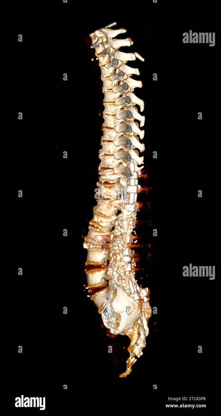 Tomodensitométrie du rachis thoracique et lombaire en 3d montrant une implantation de vis pédiculaire après décompression chirurgicale et fusion rachidienne. Banque D'Images