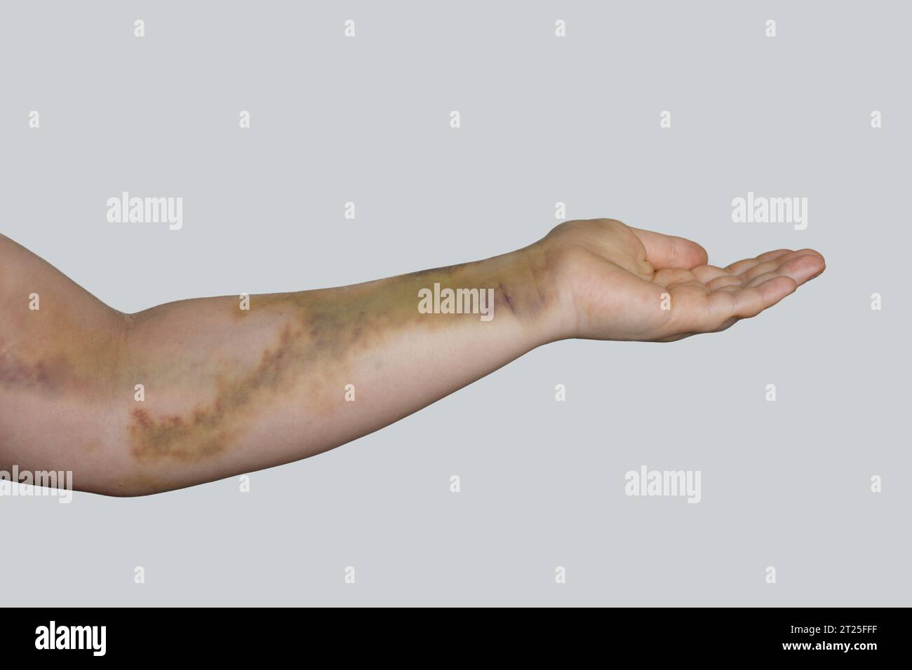 Traumatisme ecchymose d'accident de voiture sur peau féminine Banque D'Images