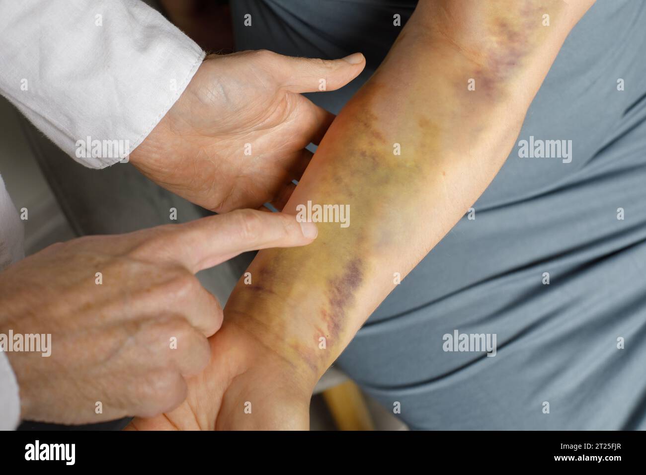 Femme avec une main contusionnée au cabinet du médecin Banque D'Images