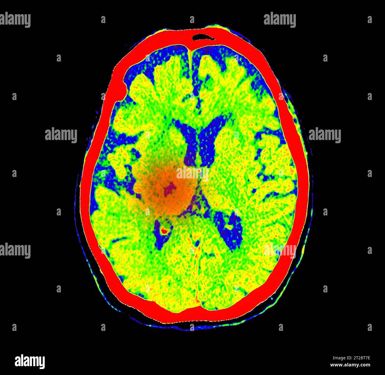 Image CT Brain perfusion ou CT scan de la vue axiale du cerveau