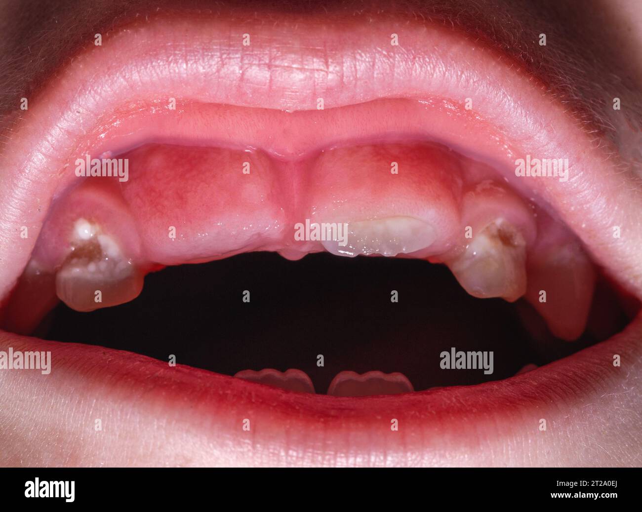 L'éruption d'une dent permanente après la perte d'une dent de lait chez un enfant, gros plan. Dentisterie pour enfants. Macro Banque D'Images