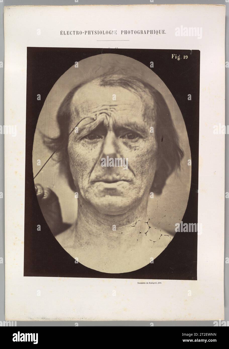 Figure 19 : souffrance Guillaume-Benjamin-Amand Duchenne de Boulogne Français Adrien Tournachon Français 1854–56, imprimé en 1862 Banque D'Images