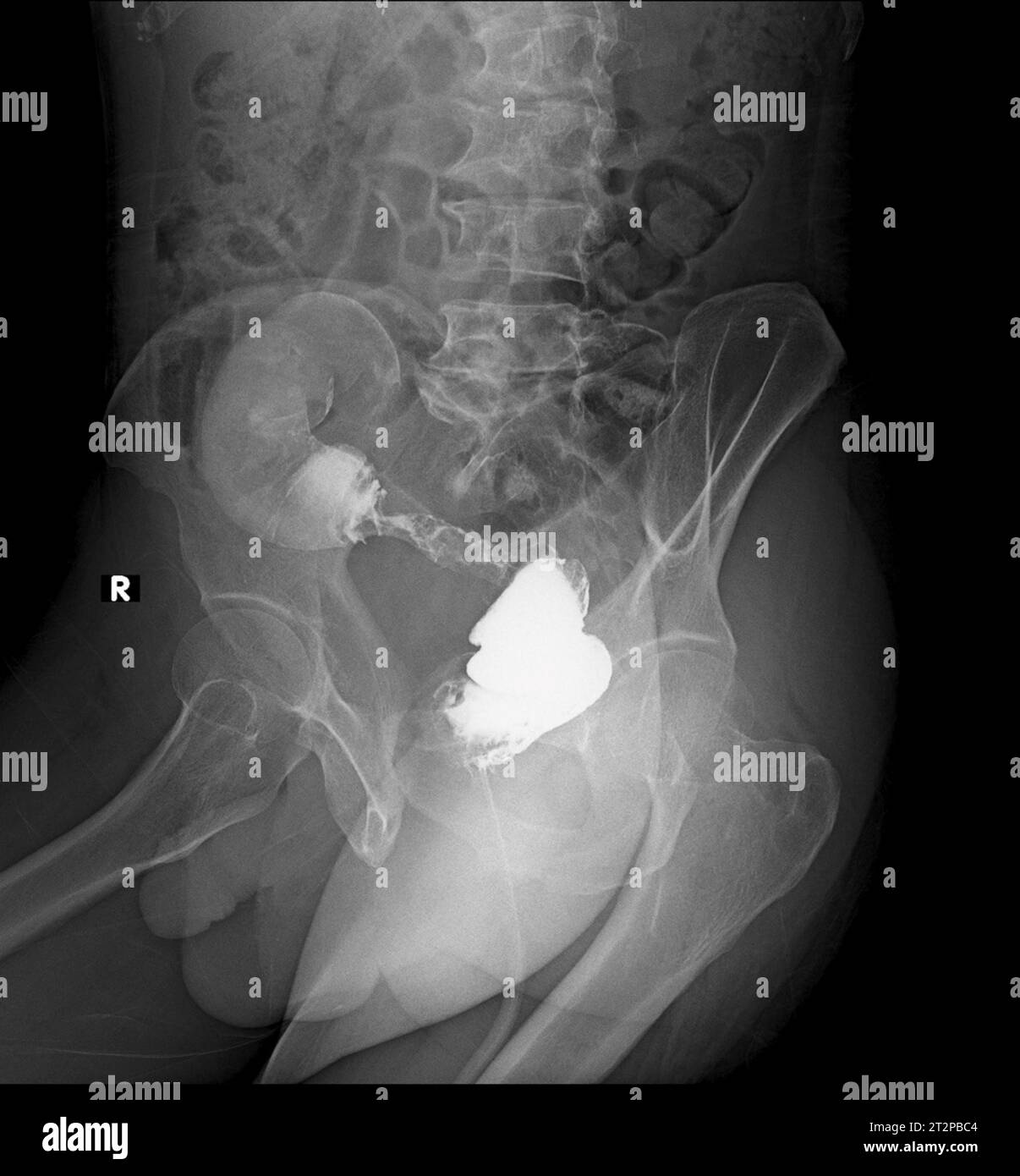 Cancer colorectal, radiographie Banque D'Images