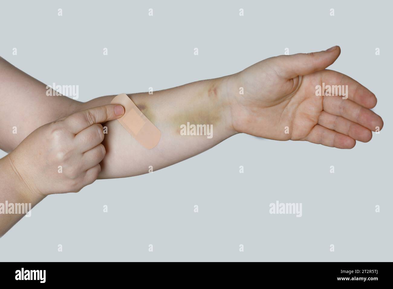 Bande d'aide de mise de main femelle sur la peau de bras avec ecchymose Banque D'Images