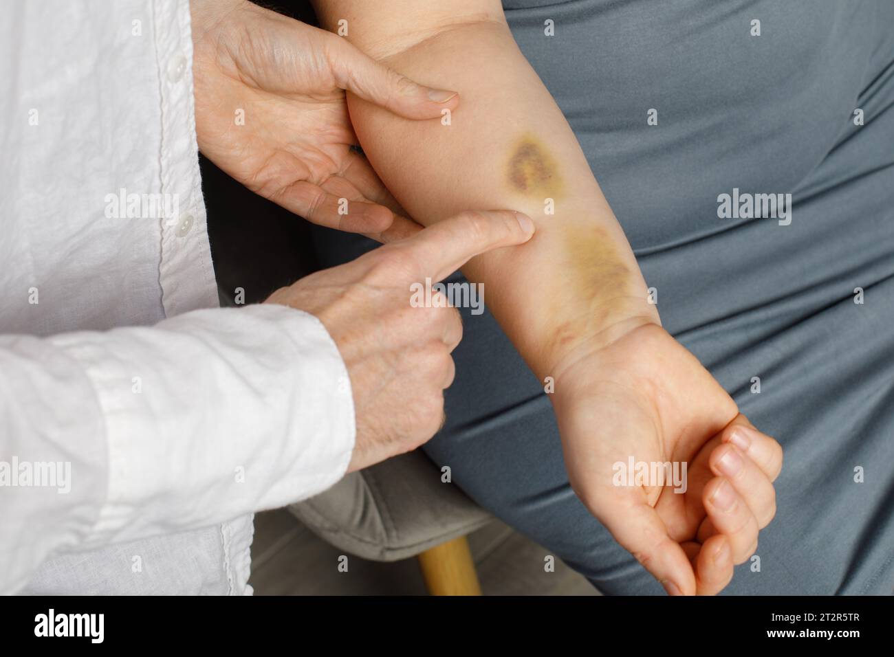 Grande contusion sur le bras humain. Ecchymoses d'injection. Médecin et patient à l'intérieur Banque D'Images