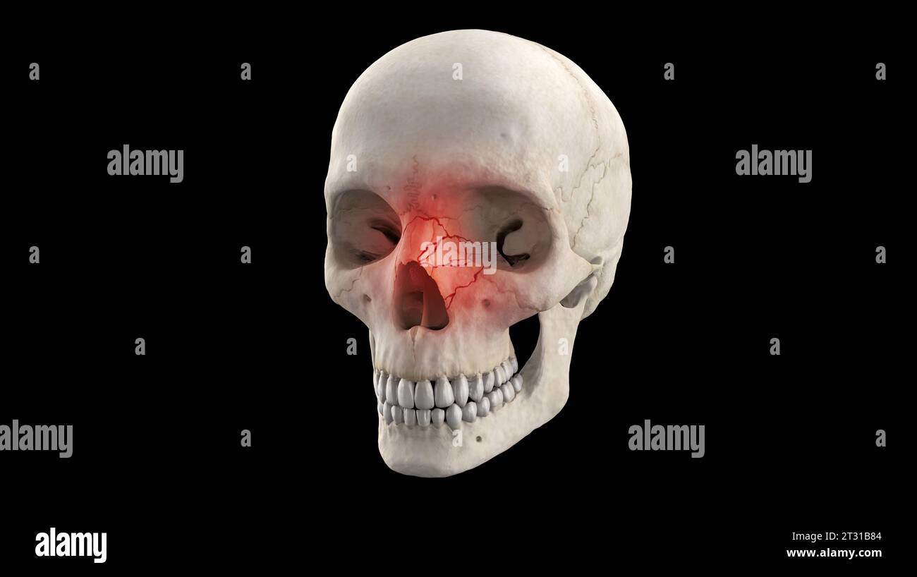 Illustration médicale 3D de fracture du nez crânien sur squelette humain Banque D'Images
