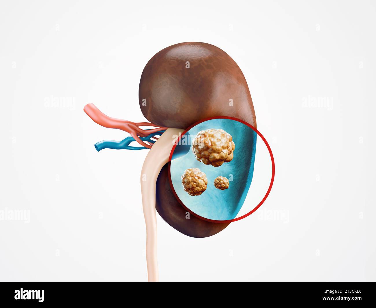 Anatomie de l'illustration réaliste 3d de l'organe interne humain - rein. Radiographie du rein humain à la recherche d'une maladie cancéreuse Banque D'Images